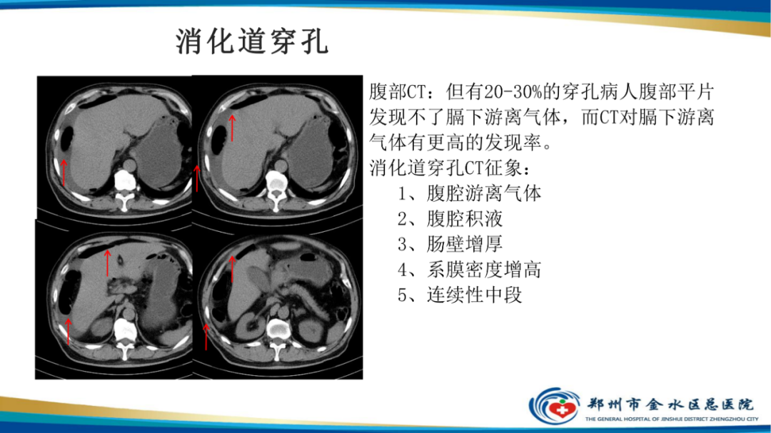 【PPT】常见急腹症的影像学诊断-17