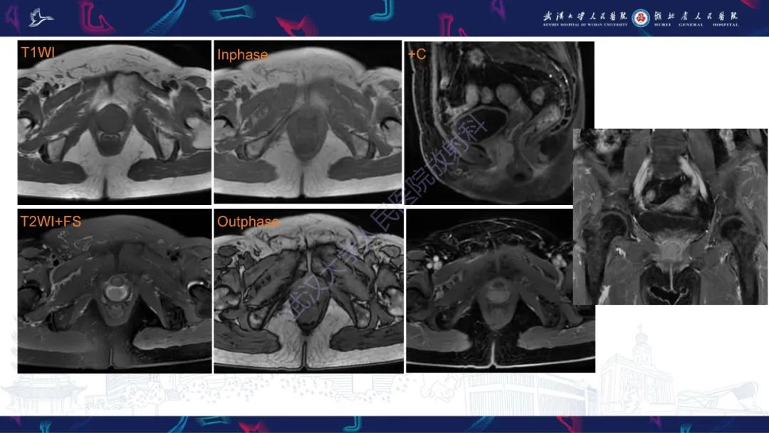 【PPT】阴道髓系肉瘤影像诊断-3