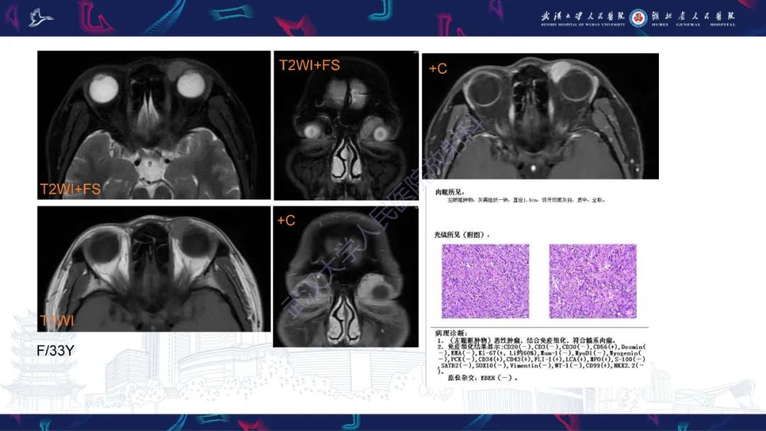 【PPT】阴道髓系肉瘤影像诊断-20