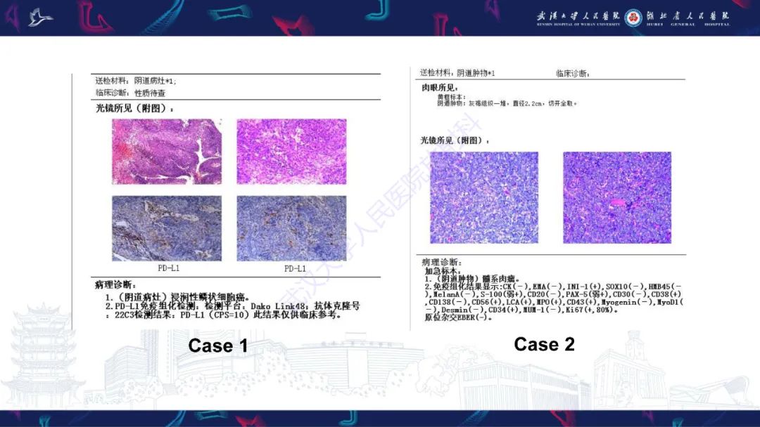 【PPT】阴道髓系肉瘤影像诊断-6