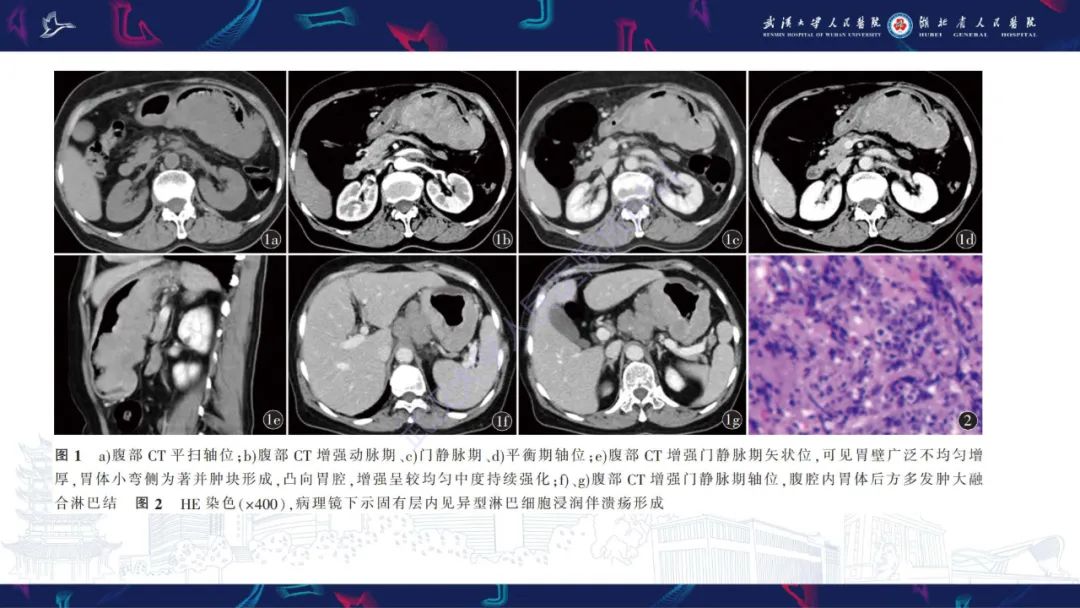 【PPT】阴道髓系肉瘤影像诊断-18