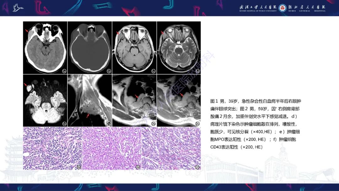 【PPT】阴道髓系肉瘤影像诊断-15