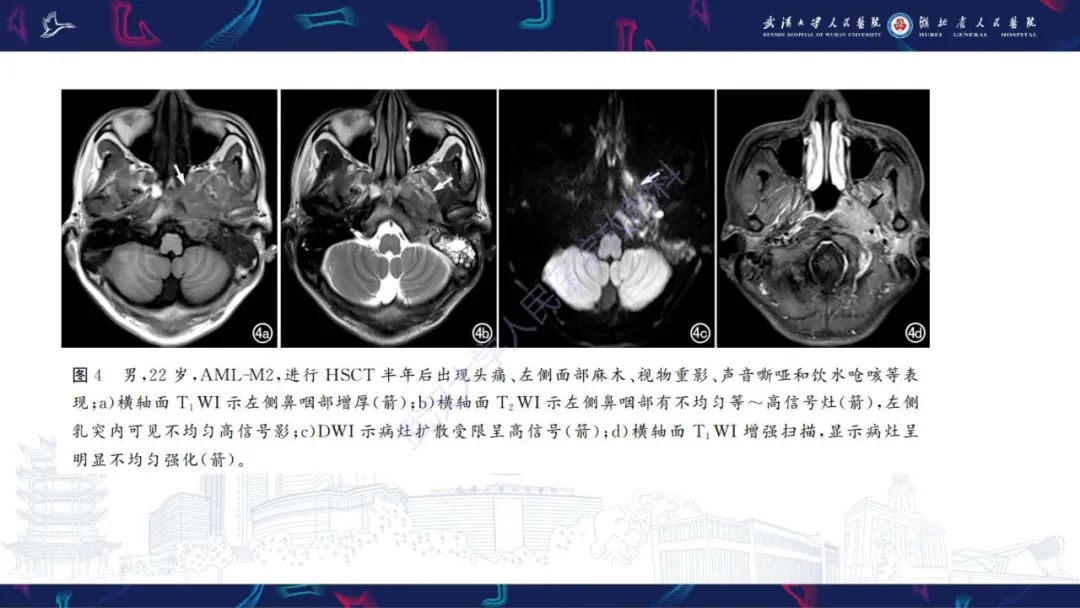 【PPT】阴道髓系肉瘤影像诊断-17