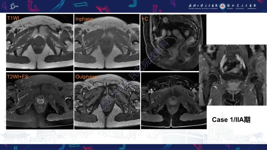 【PPT】阴道髓系肉瘤影像诊断-27