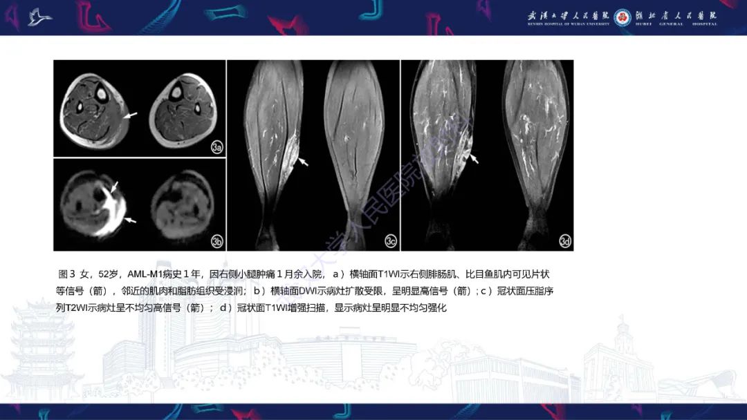 【PPT】阴道髓系肉瘤影像诊断-16