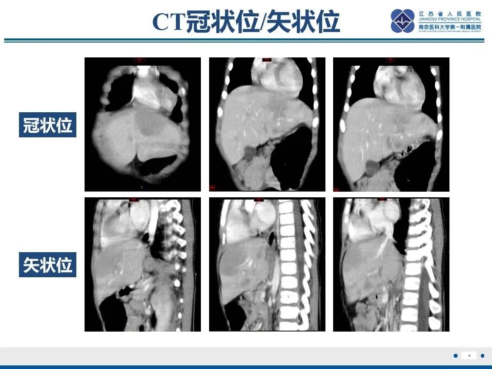 【PPT】肝淋巴瘤-5