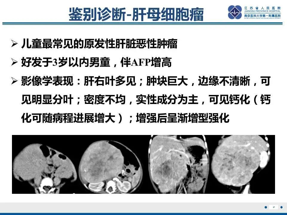 【PPT】肝淋巴瘤-28