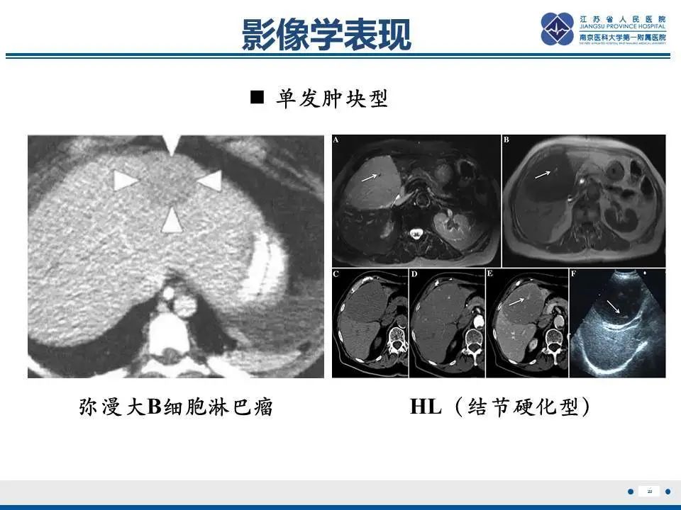 【PPT】肝淋巴瘤-21