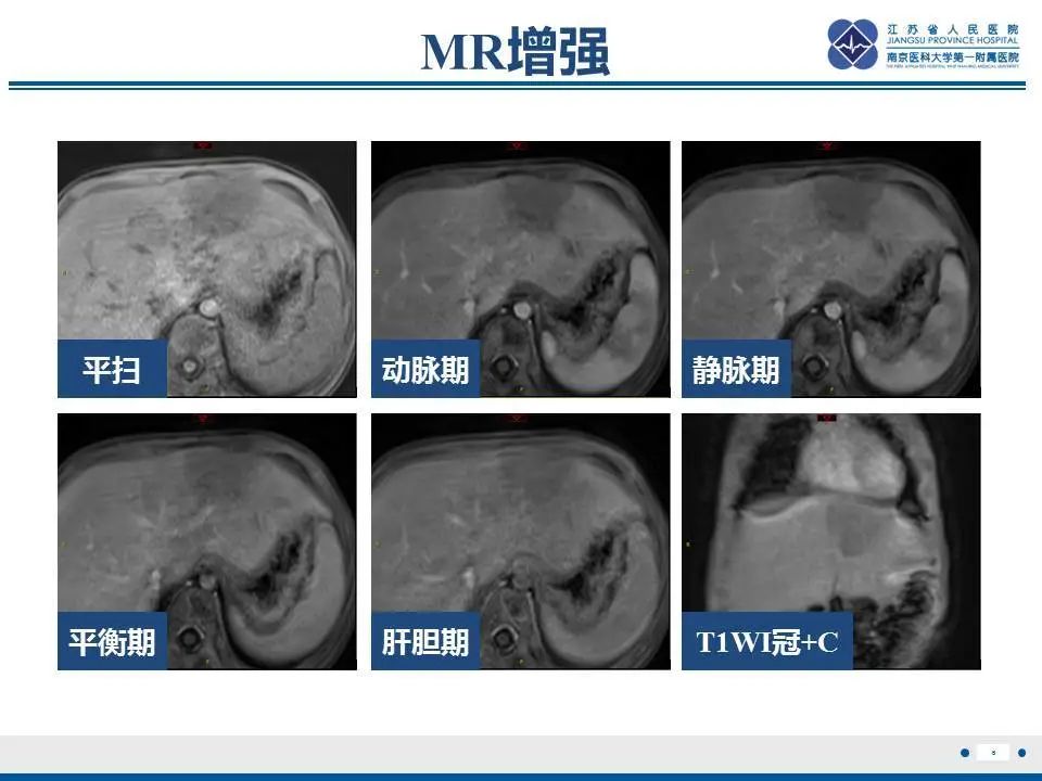 【PPT】肝淋巴瘤-7