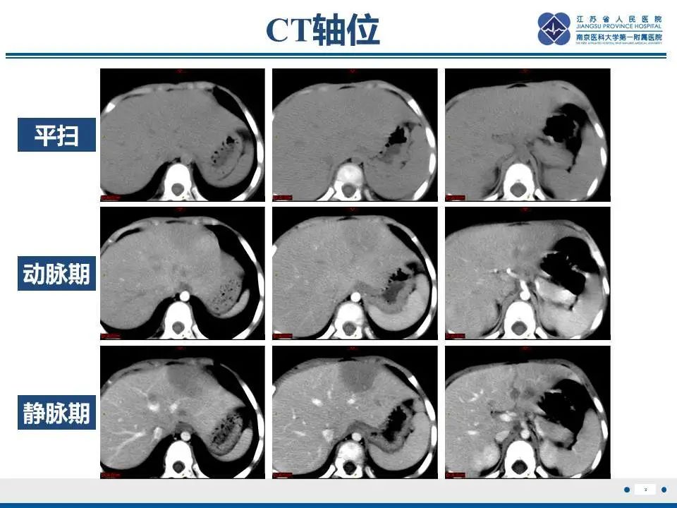 【PPT】肝淋巴瘤-4