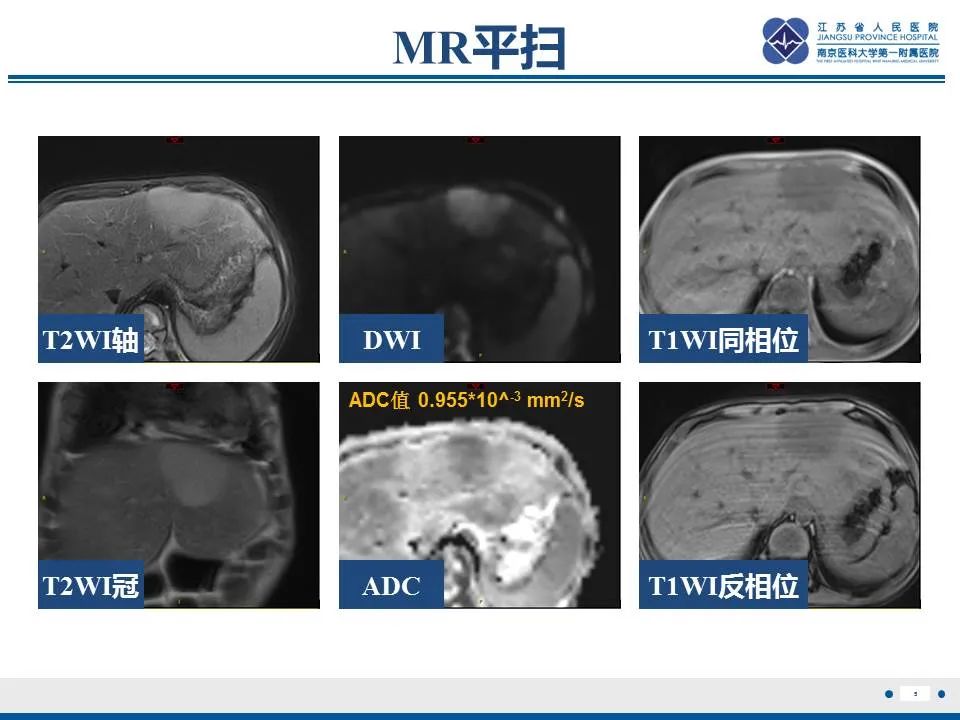 【PPT】肝淋巴瘤-6