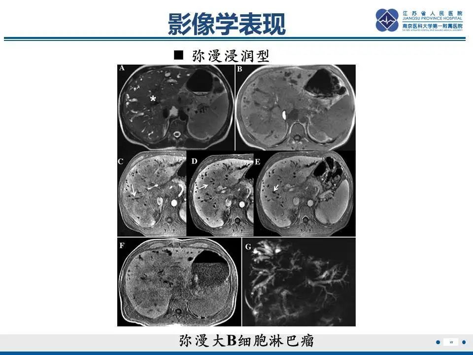 【PPT】肝淋巴瘤-23