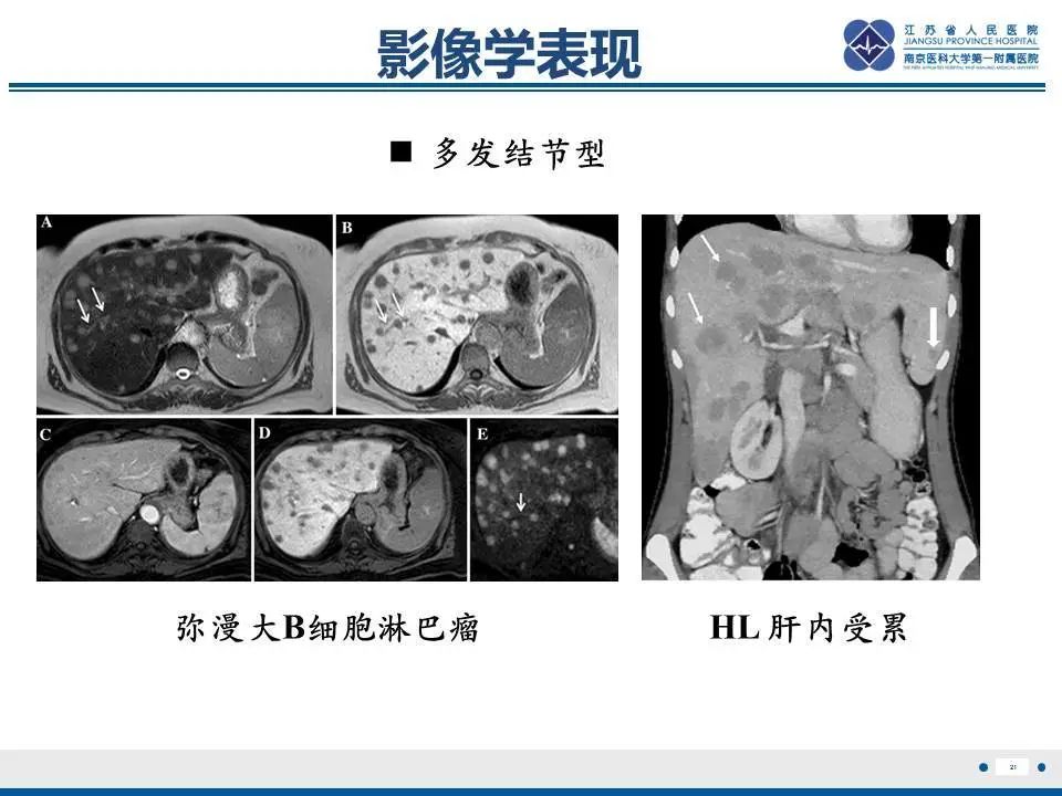 【PPT】肝淋巴瘤-22