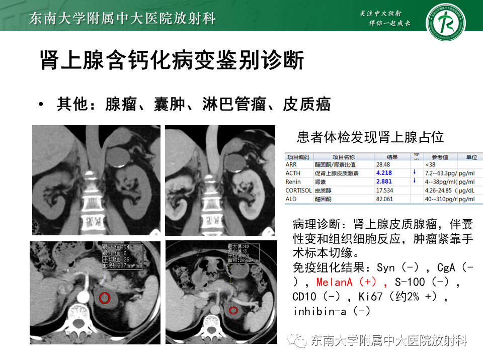 【PPT】肾上腺占位病例随访-16