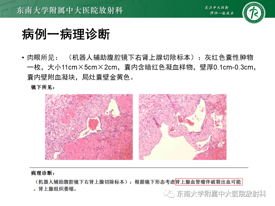 【PPT】肾上腺占位病例随访-7
