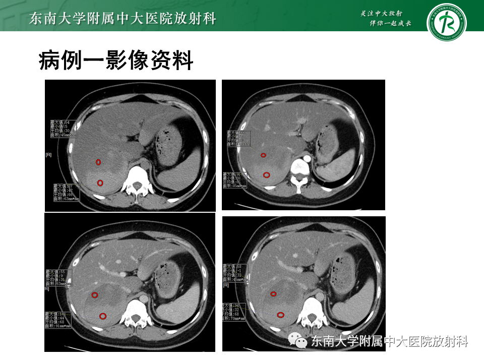 【PPT】肾上腺占位病例随访-6