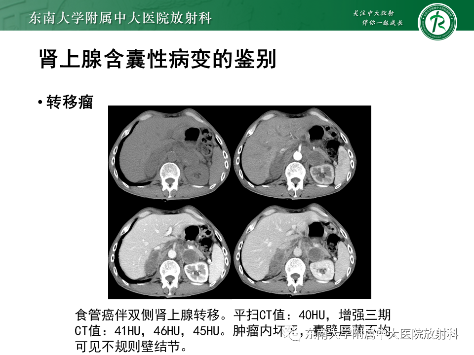 【PPT】肾上腺占位病例随访-28