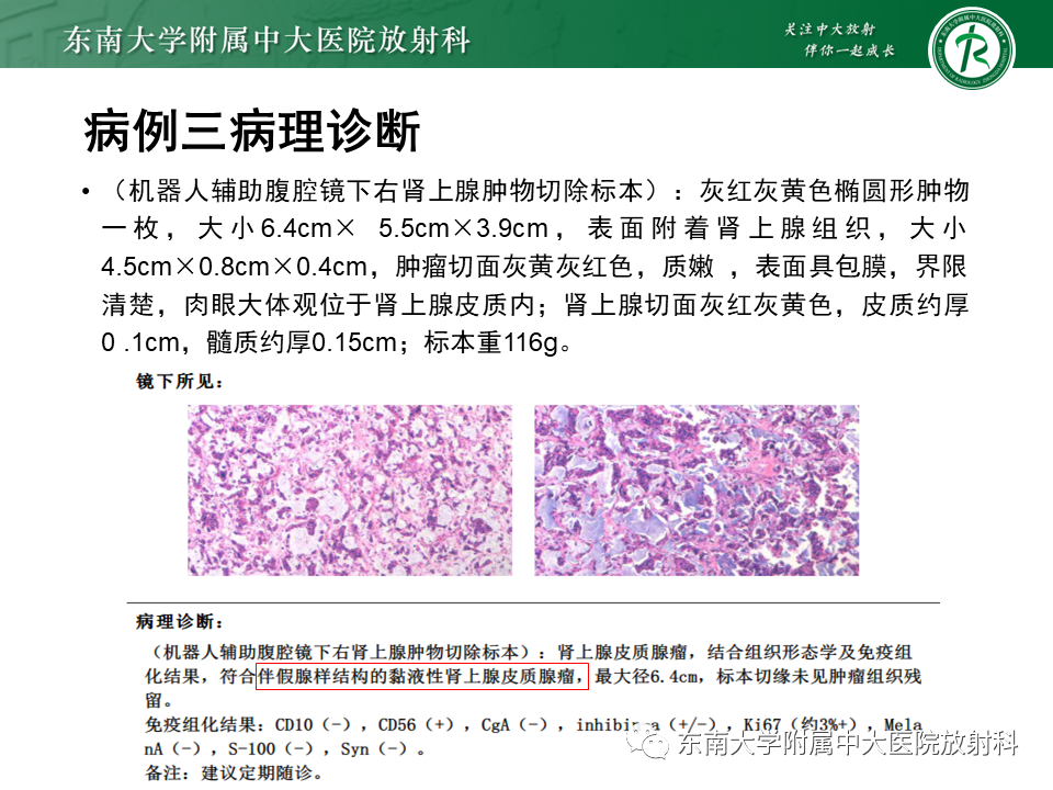 【PPT】肾上腺占位病例随访-3