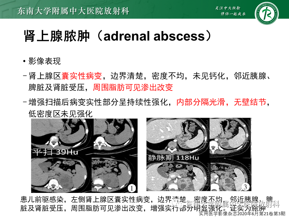 【PPT】肾上腺占位病例随访-19