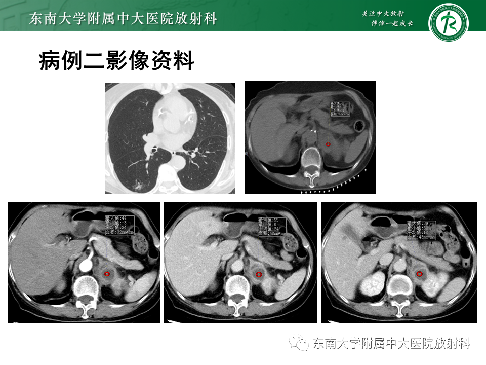 【PPT】肾上腺占位病例随访-9