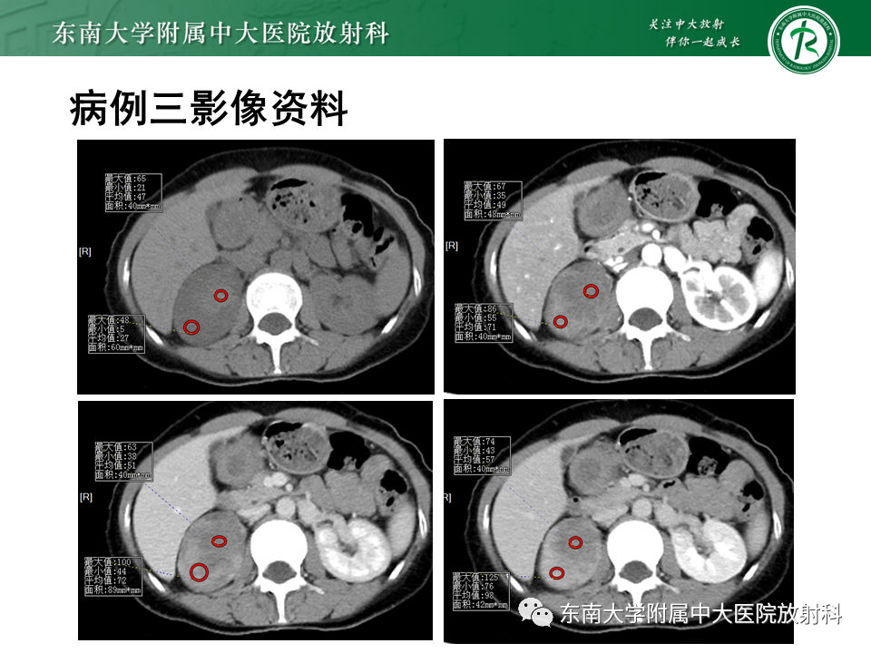 【PPT】肾上腺占位病例随访-2
