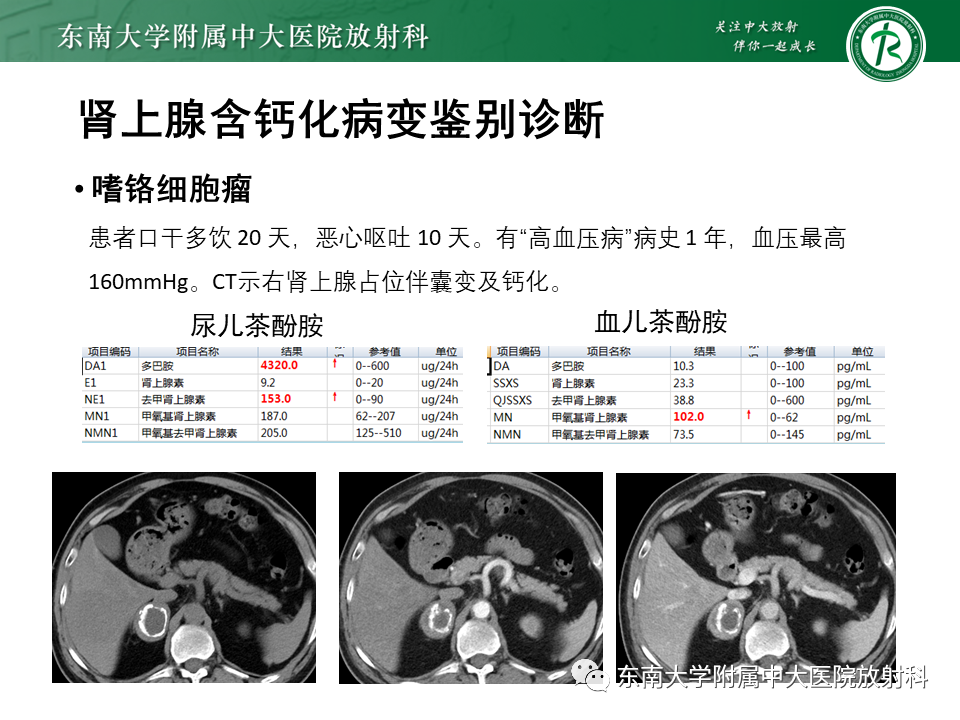 【PPT】肾上腺占位病例随访-12