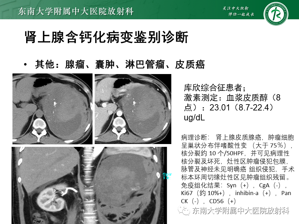 【PPT】肾上腺占位病例随访-17