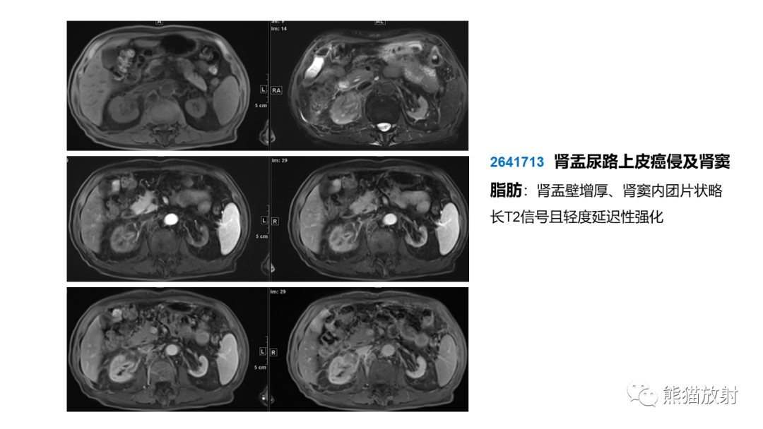 【PPT】肾窦病变影像诊断思路-40