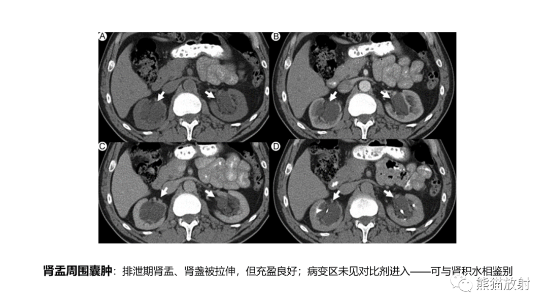 【PPT】肾窦病变影像诊断思路-27