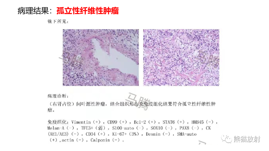 【PPT】肾窦病变影像诊断思路-17