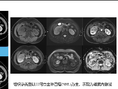 肾窦病变影像诊断思路
