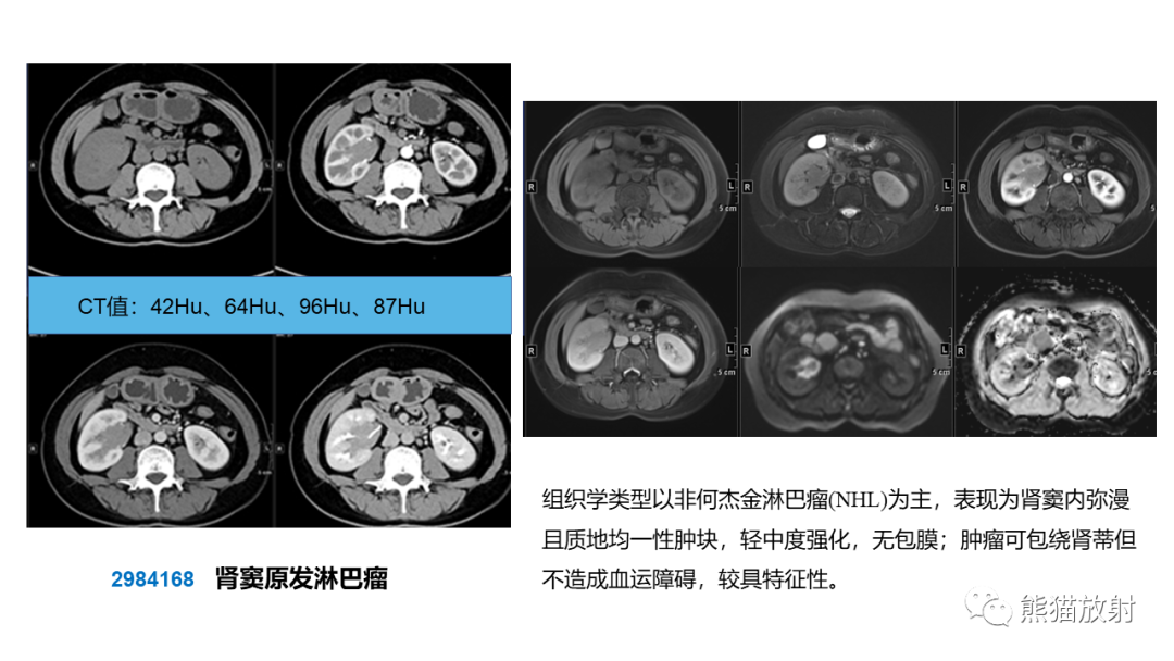 【PPT】肾窦病变影像诊断思路-44