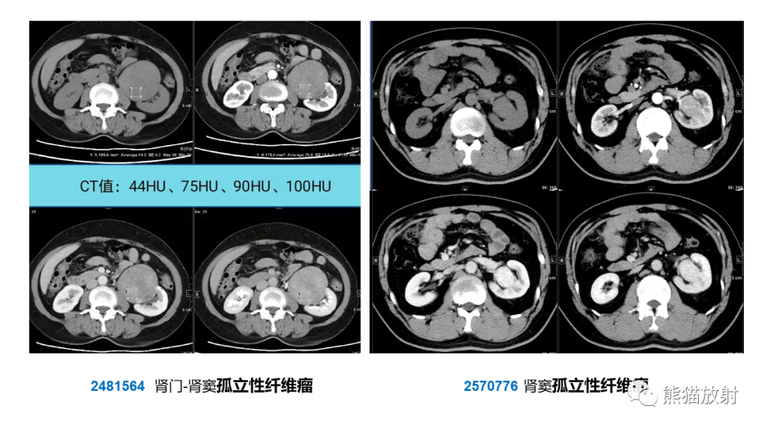 【PPT】肾窦病变影像诊断思路-43