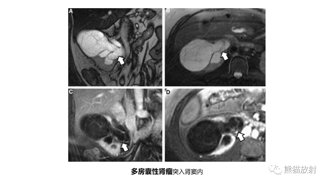 【PPT】肾窦病变影像诊断思路-47