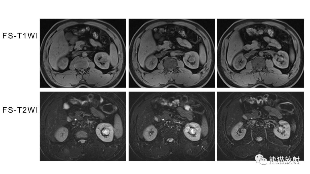 【PPT】肾窦病变影像诊断思路-7