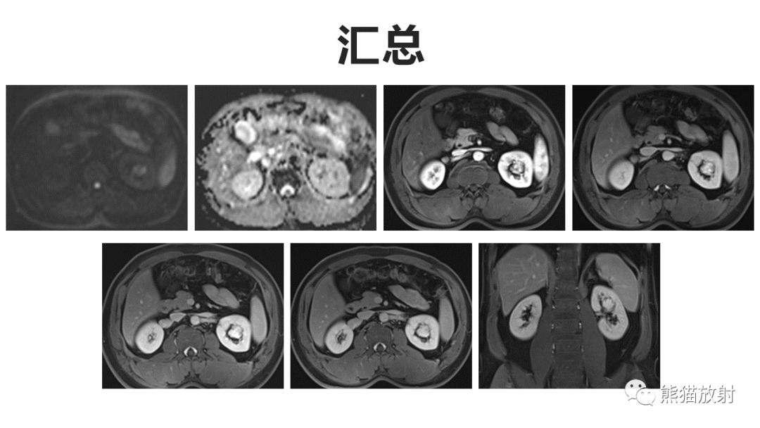 【PPT】肾窦病变影像诊断思路-4