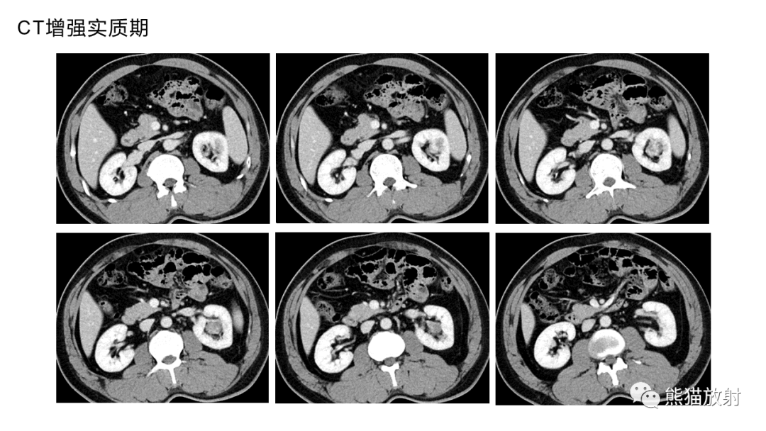 【PPT】肾窦病变影像诊断思路-5