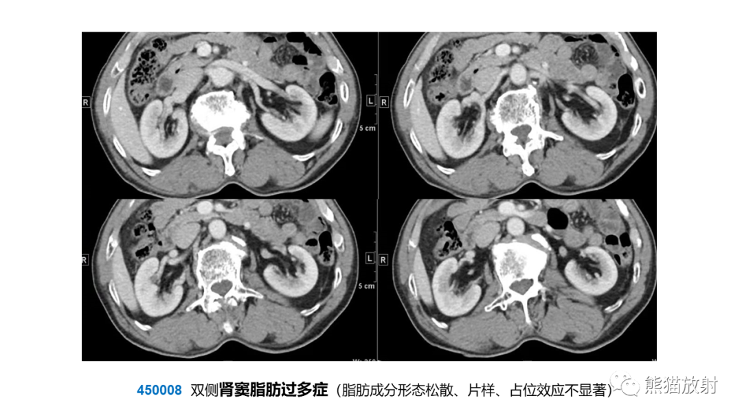 【PPT】肾窦病变影像诊断思路-24