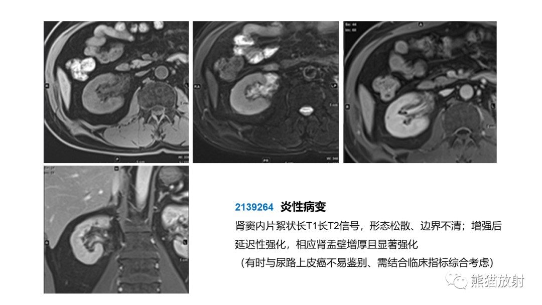 【PPT】肾窦病变影像诊断思路-36