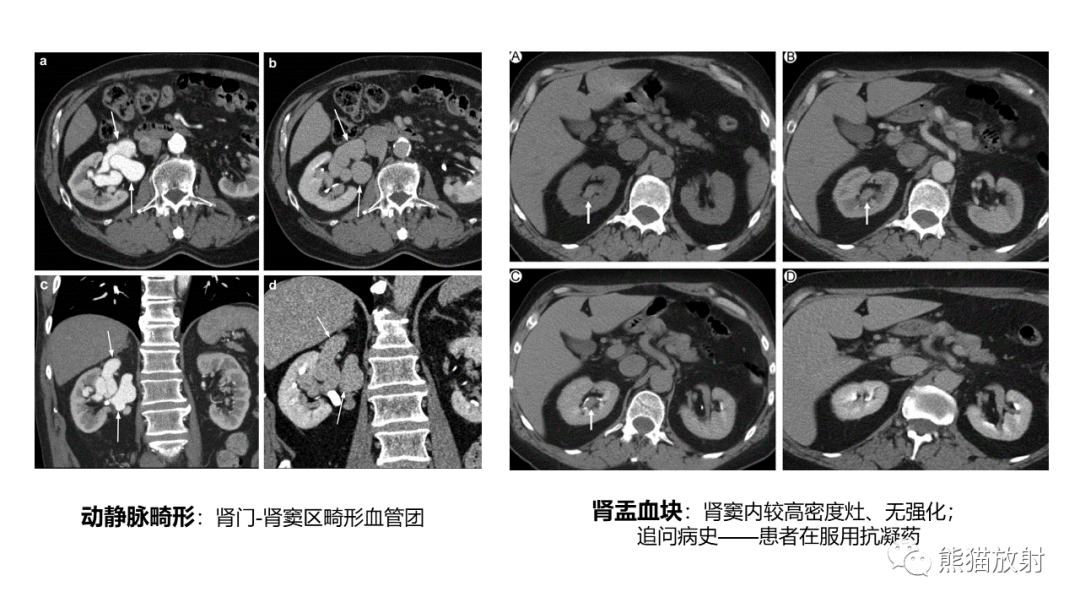 【PPT】肾窦病变影像诊断思路-33