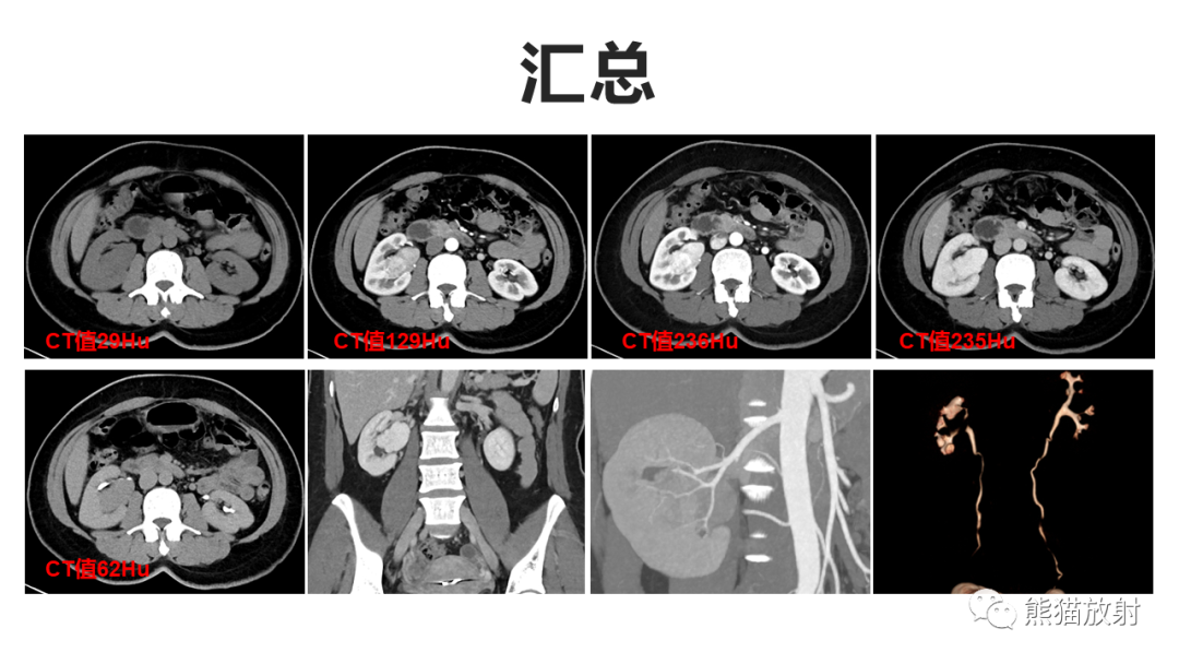 【PPT】肾窦病变影像诊断思路-10
