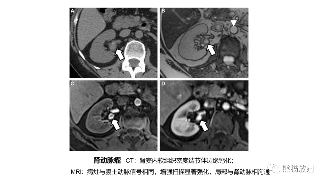 【PPT】肾窦病变影像诊断思路-32