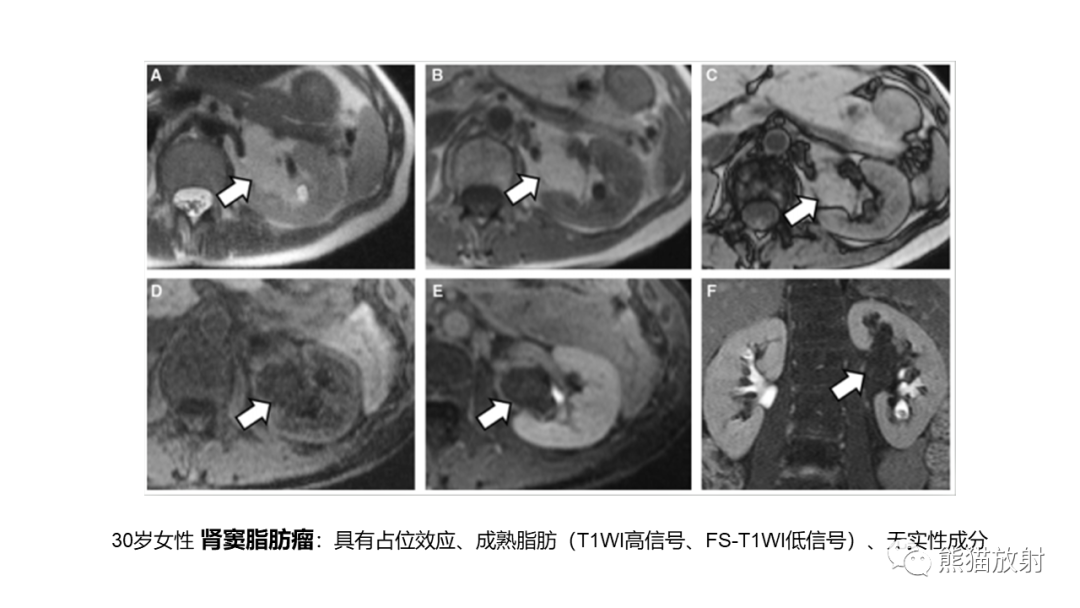 【PPT】肾窦病变影像诊断思路-23