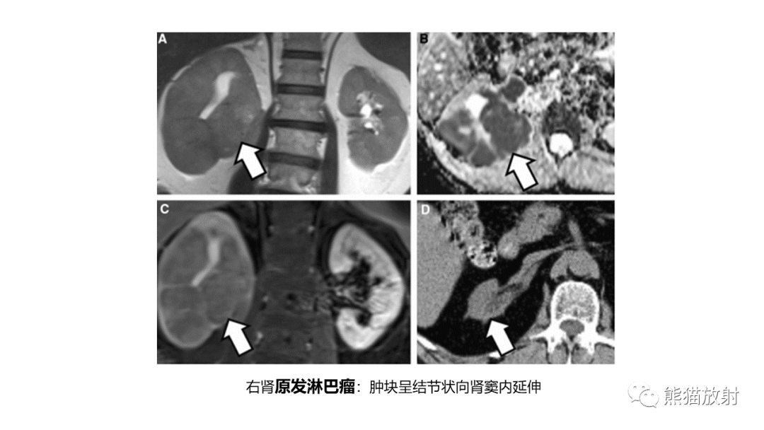 【PPT】肾窦病变影像诊断思路-48