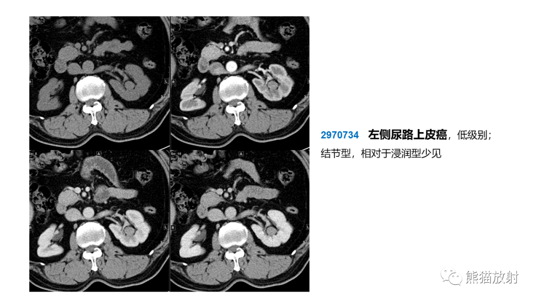 【PPT】肾窦病变影像诊断思路-41