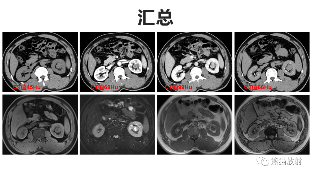 【PPT】肾窦病变影像诊断思路-3