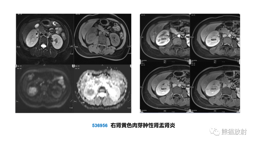 【PPT】肾窦病变影像诊断思路-37