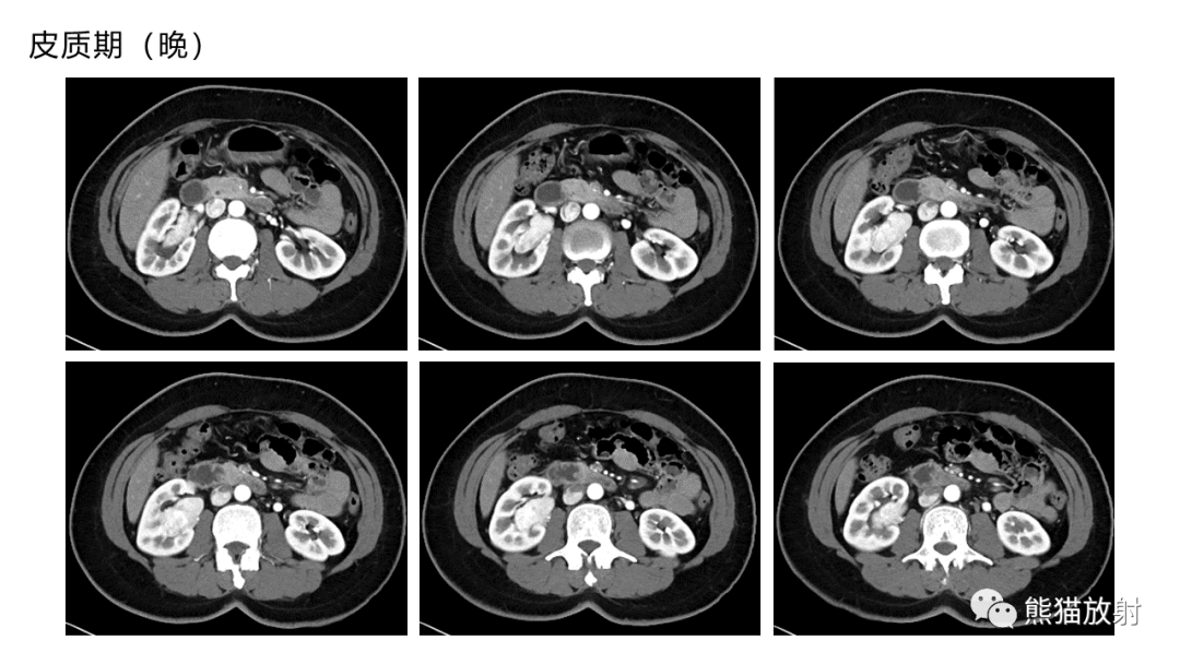 【PPT】肾窦病变影像诊断思路-11
