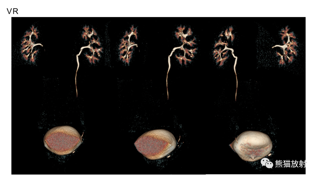 【PPT】肾窦病变影像诊断思路-6