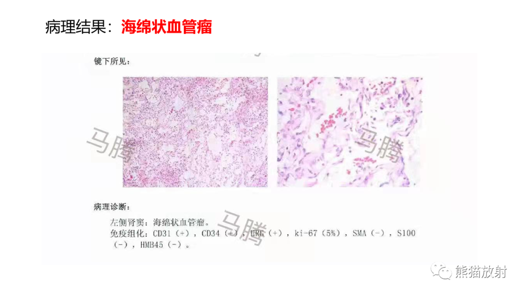 【PPT】肾窦病变影像诊断思路-15